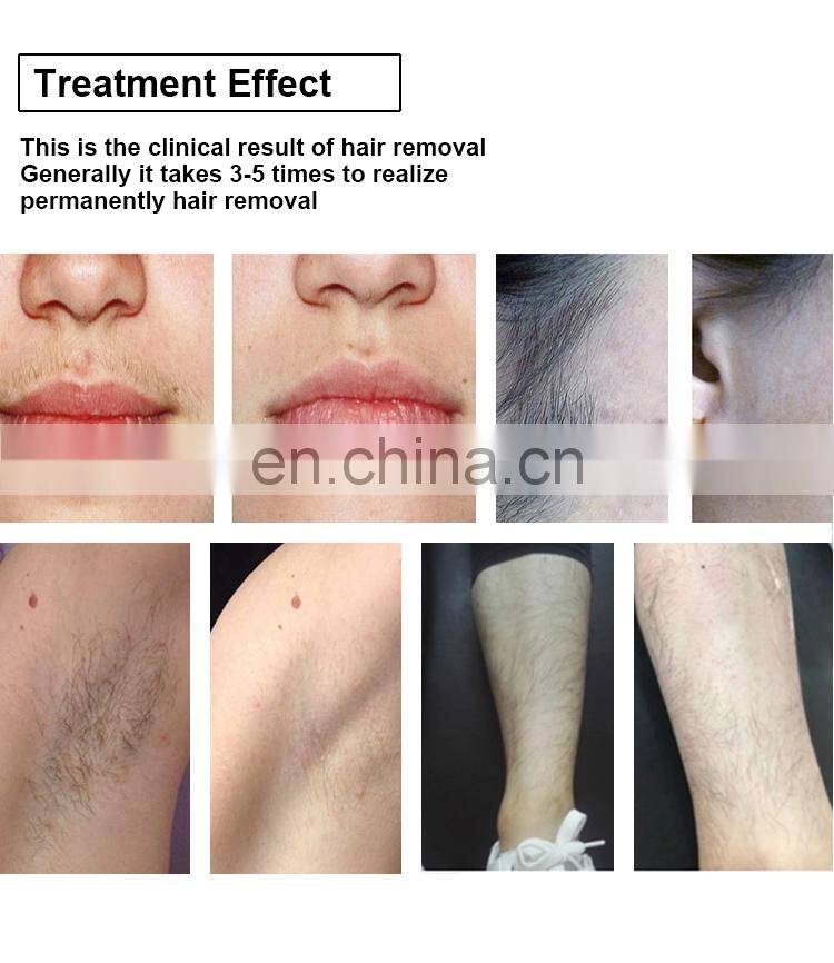 High-grade Diode Laser System Epilation 808nm Diode Laser Hair Removal Laser Machine For Sale