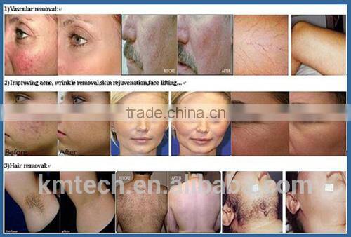 Cheaper and higher quality portable e-light machine with IPL system