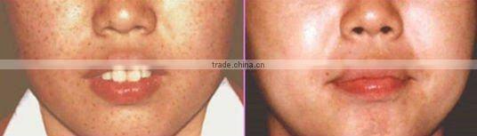 E Light Ipl & Rf Hair Removal Skin Rejuvenation on sale