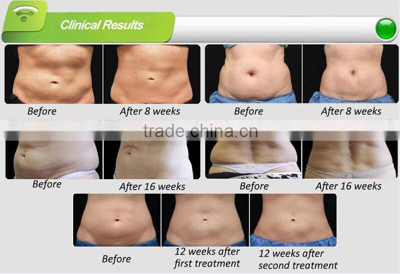 2016 Hot Selling!!! criolipolise machine for home use/criolipolise machine price