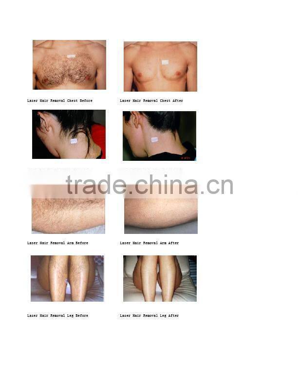 808 laser 2500 W 10 * 20 mm sapphire size hair removal machine DH 03