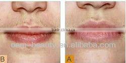 laser depilator long pulse laser permanent hair removal beauty equipment