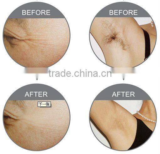 Permanent hair removal freckle removal stretch mark removal beauty machine C006