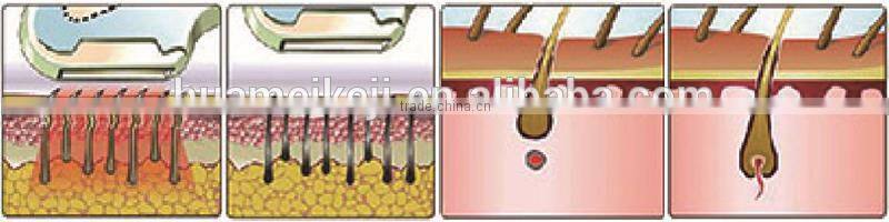 2015 New vertical Permanent ipl&diode laser hair removal machine (CE)