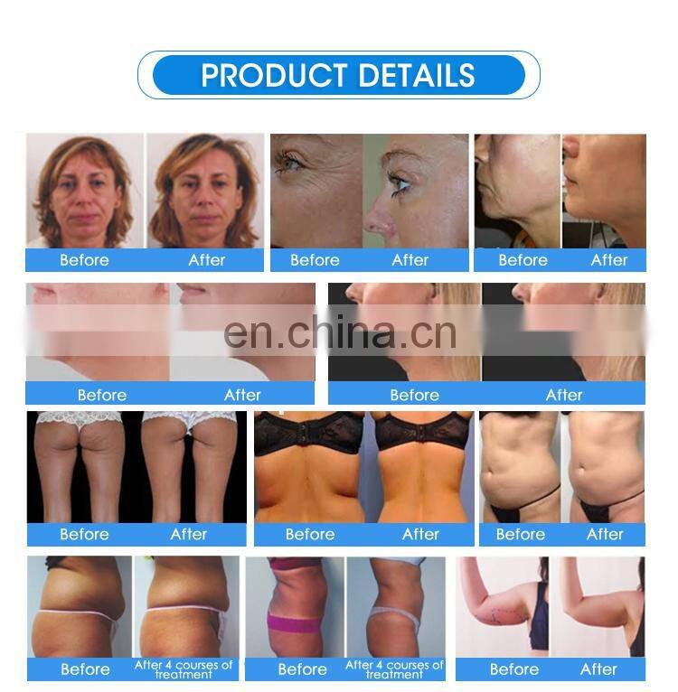 Non-invasive non-surgical 2 in 1 RF ultrasound face neck body skin tightening wrinkle removal device