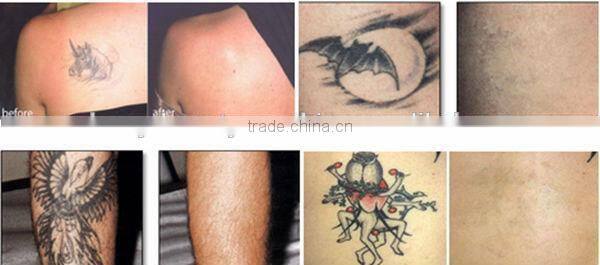 2014 New product 532nm 1064nm portable tattoo removal laser/machine With CE