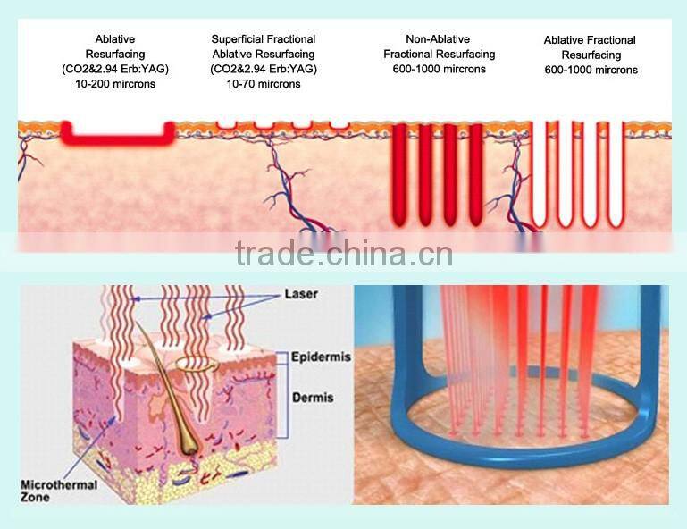 Newest Generation!! Beauty Device Fractional CO2 Laser Equipment Vaginal Tightening Machine with FDA