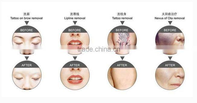 High quality E11C - Erica Q- switch nd yag laser tattoo removal ipl shr laser hair removal