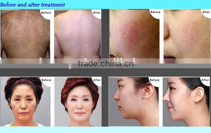 SHR and STR German 10Hz Fast Hair Removal ipl shr laser machine with CE