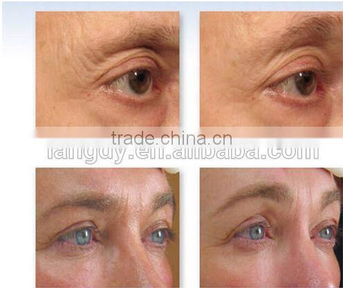 Ultrasound therapy hifu facelift wrinkle removal spa use machine