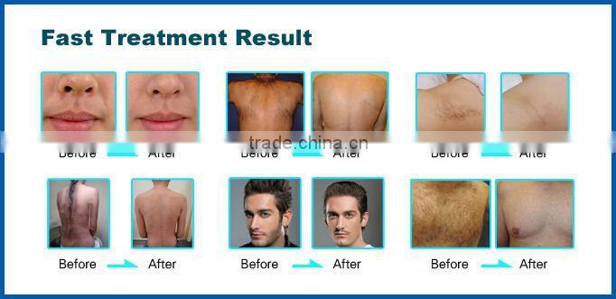 Best and most effective ipl laser beauty equipment for hair removal