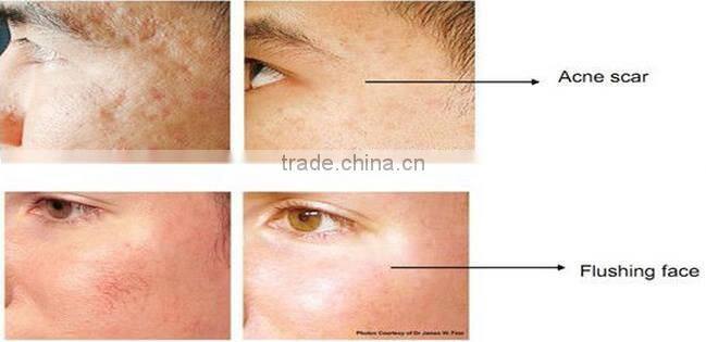Best Matrix rf fractional with microneedle machine for wrinkle removal