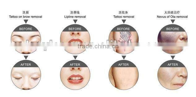 Professional tattoo removal equipment