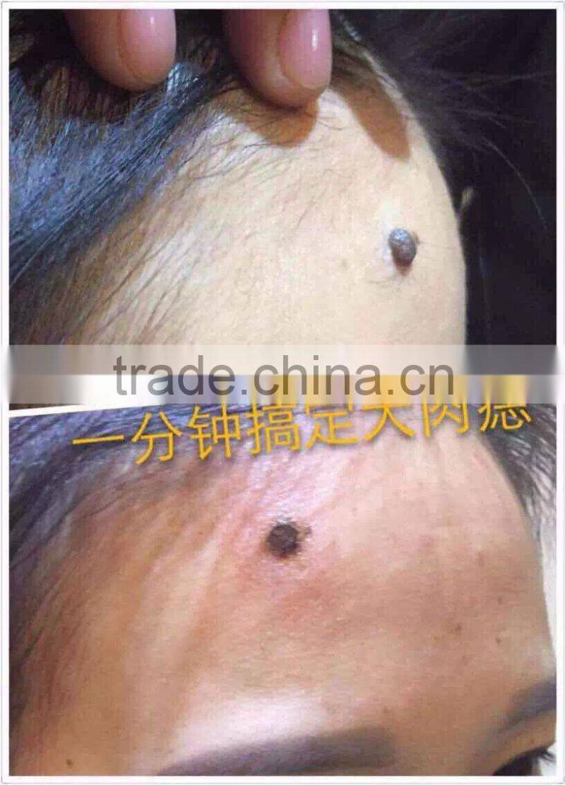 2015 New Wholesale Professional mini Tatoo Spot Mole Laser Remover freck spot removal laser pen