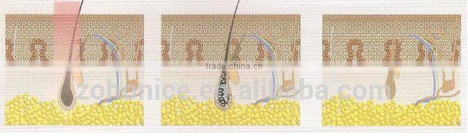 Y9C lumenis laser light 808nm diode laser hair removal