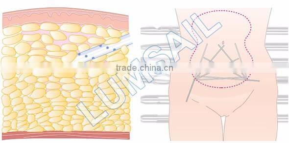 Power Assisted Surgical liposuction equipment