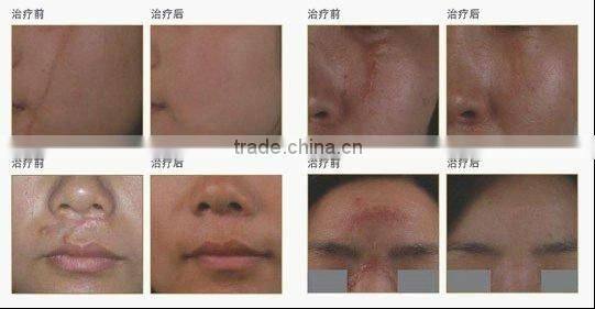 face cleaning cream super CO2 fractional laser