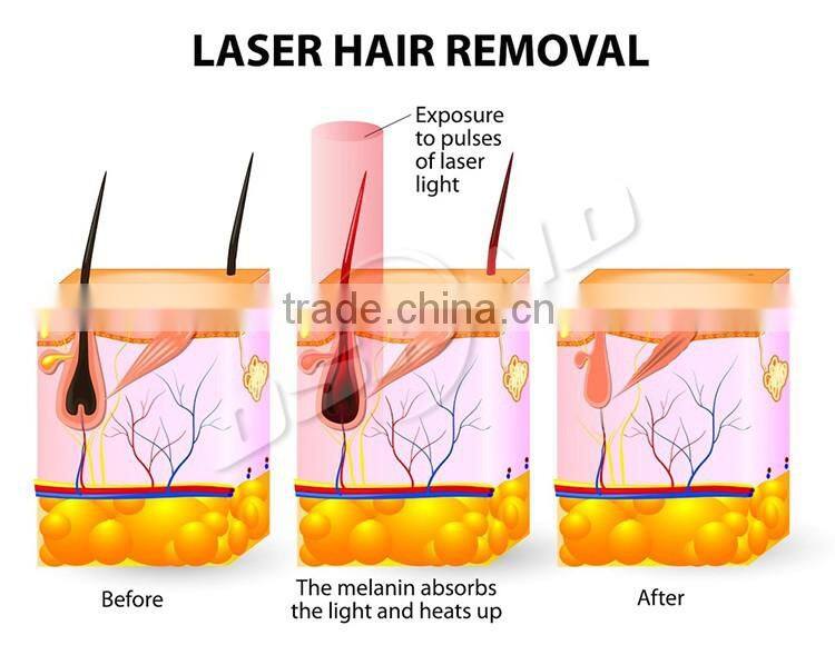 Mini IPL Hair Removal Salon Wanted For Sale