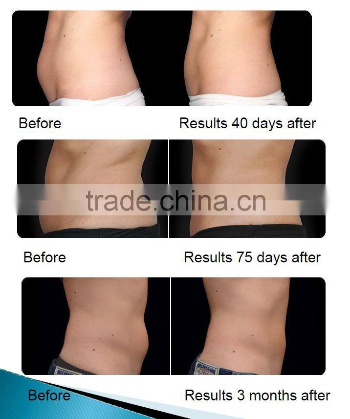 The advanced vacuum shape for body slimming/vela shape massage