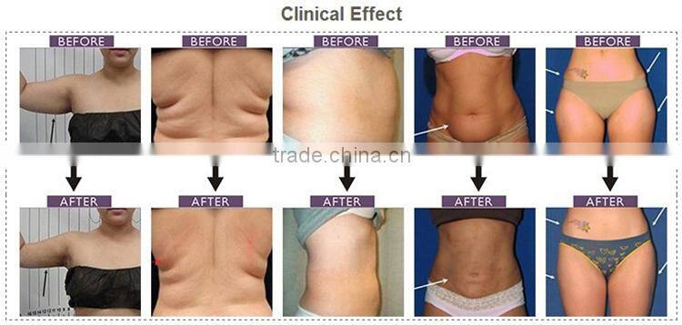 chinese weight loss product/portable 650nm lipo laser for cellulite reduction