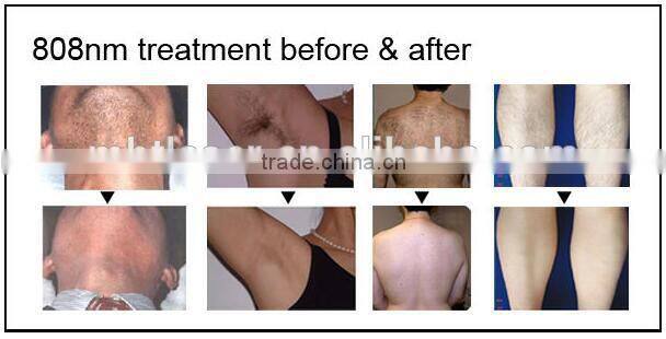 Germany bars portable 808nm diode laser laser hair removal machine for sale