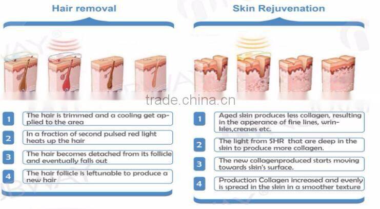 Korea technology Permanent hair removel wrinkle and acne removal opt shr hair removal machine in china