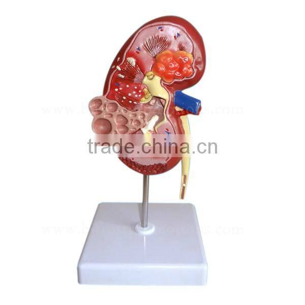 Pathological Medical Human Body Anatomy Model Kidney