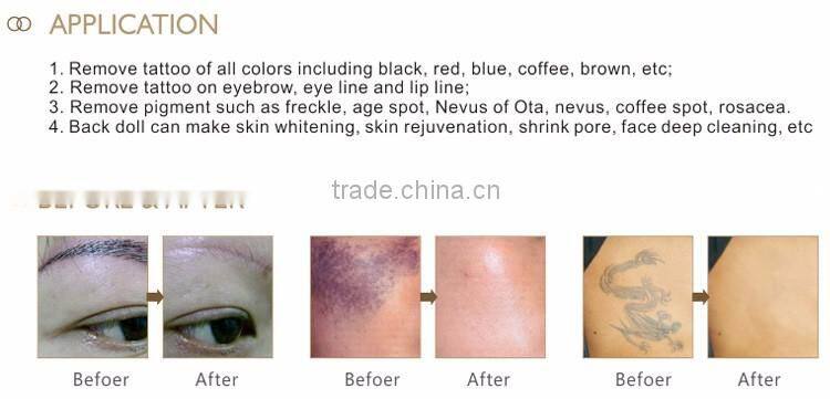 New design q switched alexandrite laser tattoo removal equipment