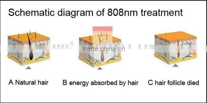 distributor wanted non invasive all skin laser epilator 808nm hair removal diode