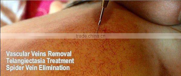 Spider Vein Removal Varicose Veins Laser Treatment Machine V600