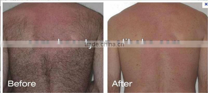 epilator pulsed light ipl skin rejuvenation machine A003