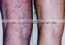 epilator pulsed light ipl skin rejuvenation machine A003