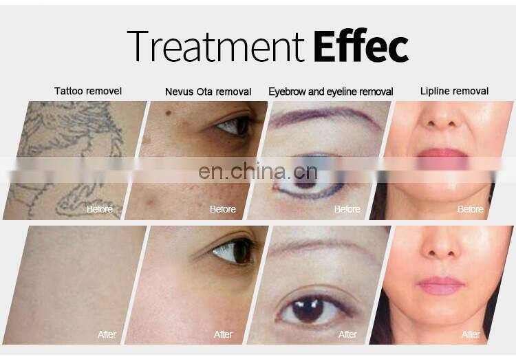 Portable 1064 532 1320nm nd yag laser carbon peeling yag laser machine