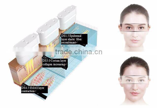 best effect professional home use hifumachine smart hifus skin care machine