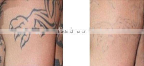 Zhengjia medical skin care machine/ facial tightening equipment with CE