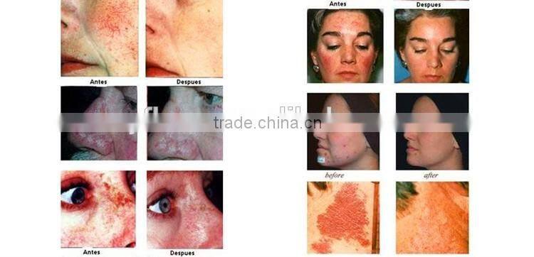 Portable pdt/led skin care product