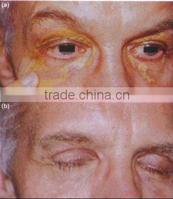 1064nm&532nm Q-switch Nd:YAG laser machine