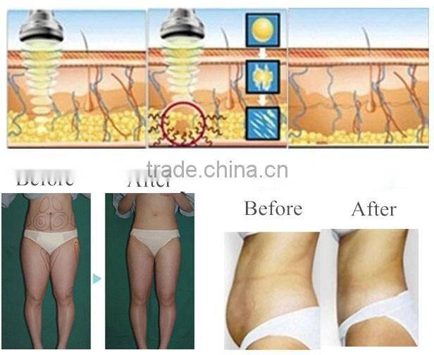 Cryolipolysis Cavitation RF Skin tightening Face Lifting Machine