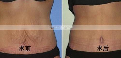 New Designed Bipolar RF Skin Tightening Face Lifting Beauty Equipment Price