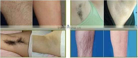 808nm diode laser hair removal machine portable laser hair removal machine