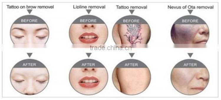 2016 professional vertical nd yag laser hair removal machine