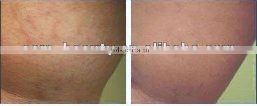 Mini scar removal 540 titanium needles derma roller with extra head NSR-540