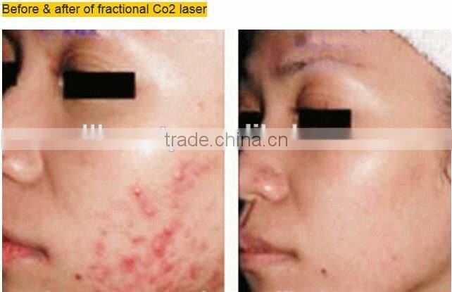 Beauty (CE certificate) USA RF tube Fractional CO2 laser vaginal tightening