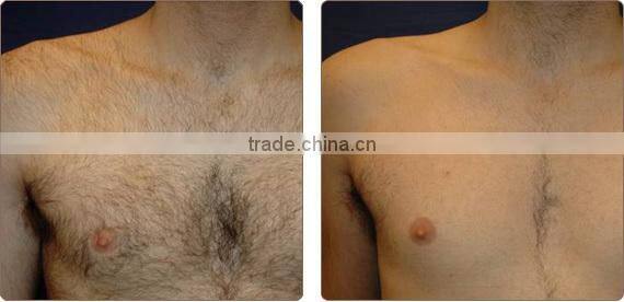 Different shell color home ipl hair removal system for body