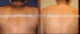 hot in Europe diode laser hair removal distributors wanted for sale