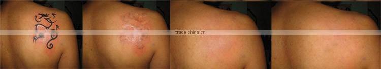new high energy Q-switched ND YAG laser tattoo removal machine