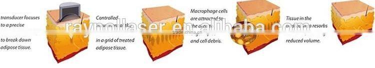 Ultrasonic Liposuction Body Shape Slimming Equipment