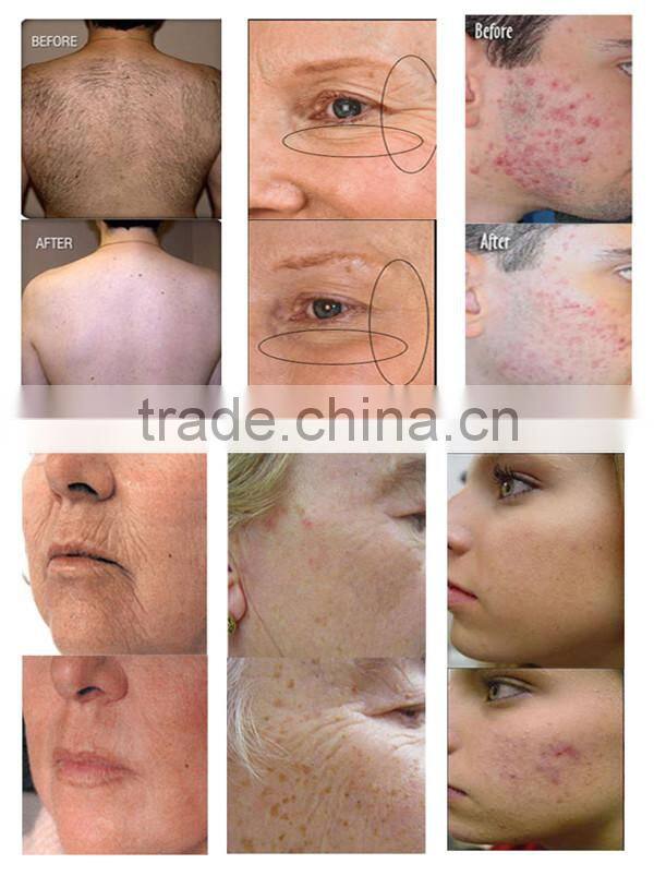 50% off big promotion best price ipl diode laser hair removal machine price