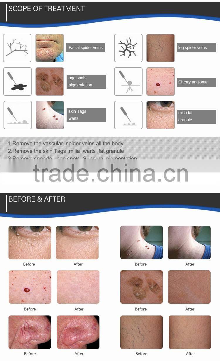 2016 Hot Distributor Wanted High Quality Laser Vascular Spider Vein Removal/Varicose Vein Removal Machine Price For Sale