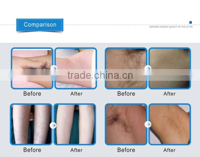 Permanent Hair Removal Diode Laser Hair Removal Hot Sale 808nm